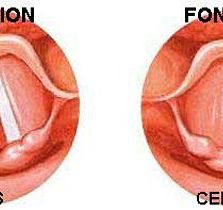 Clínica Otorrinolaringológica del Dr. Bernardino Cano ilustrado de las cuerdas vocales
